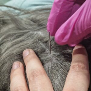 suche igłowanie, dry needling