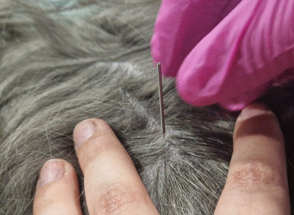 suche igłowanie, dry needling